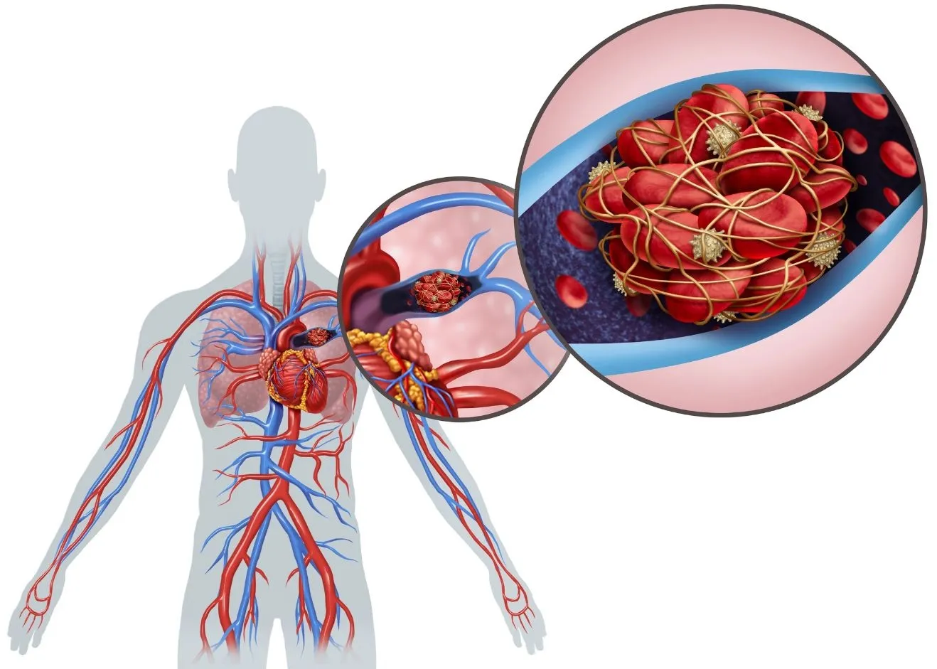 PULMONER EMBOLİ